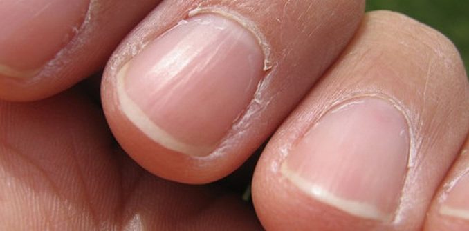 7-problemas-nas-unhas-o-que-eles-dizem-sobre-sua-saude-e-como-cuida-2