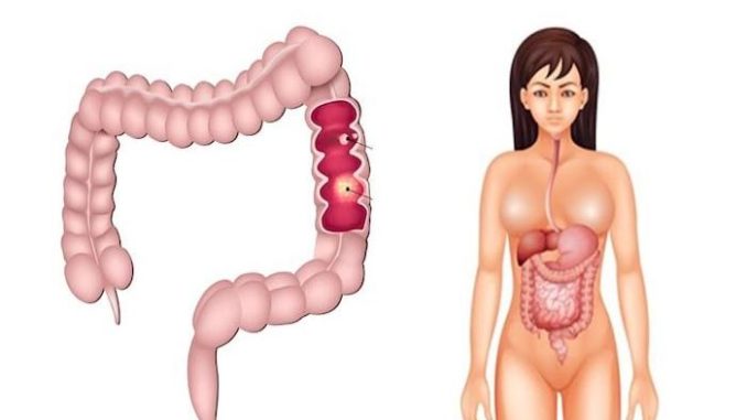 colorectal-wp-700x440