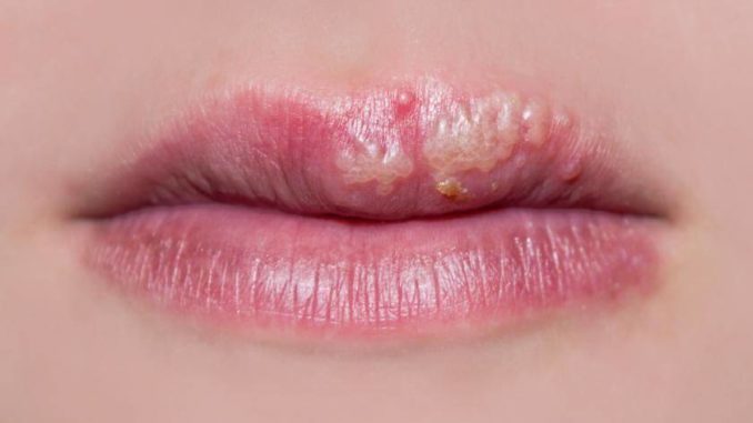 herpes-herpesecure